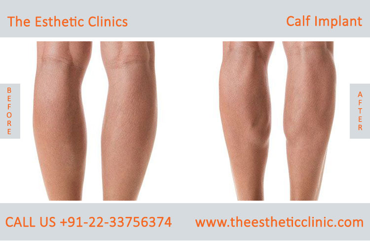 Calf implants, Calf Augmentation surgery before after photos in mumbai india (1)